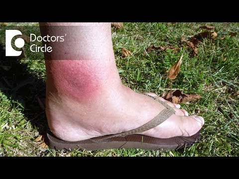 How to manage spider bite with swelling & redness? - Dr. Nischal K