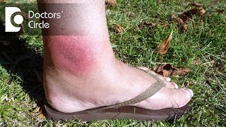 How to manage spider bite with swelling & redness? - Dr. Nischal K