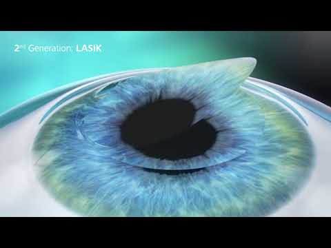 What is the difference between PRK, LASIK and ReLEx SMILE