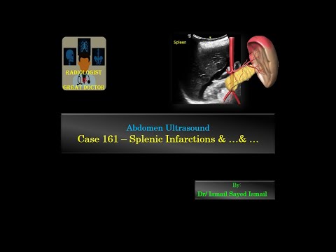 Ultrasound Case 161 - Splenic Infarctions &