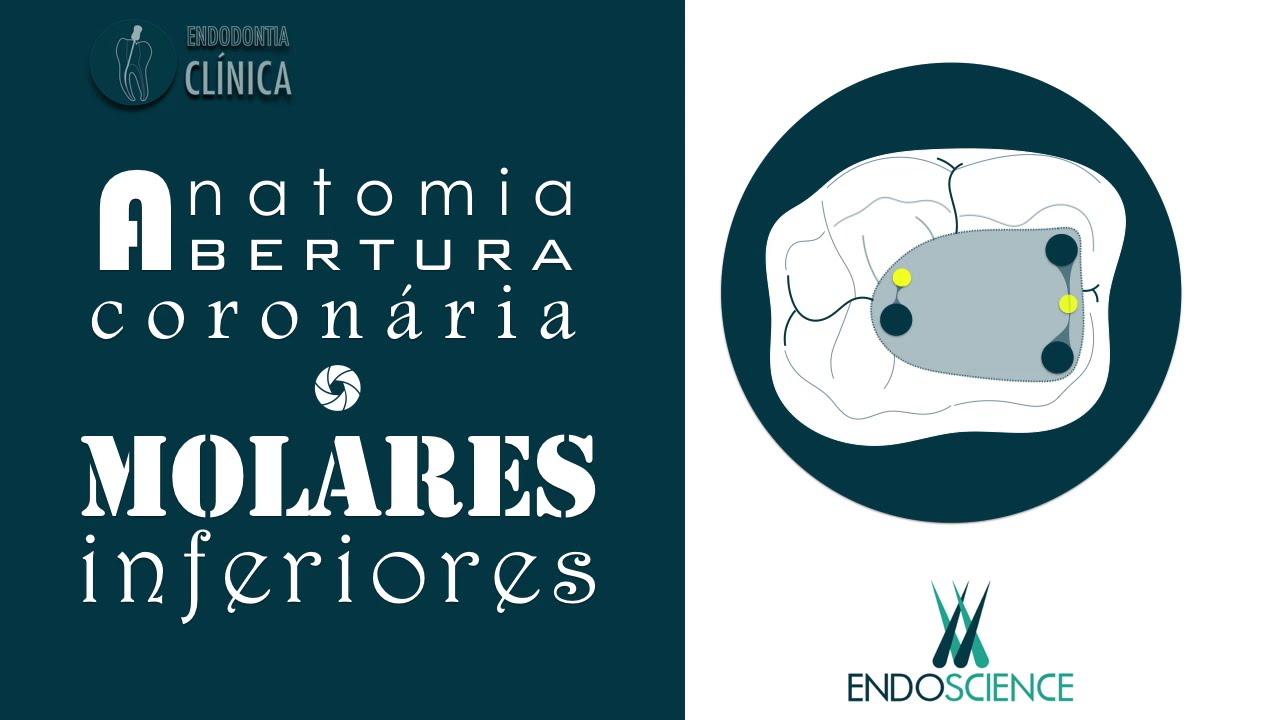 Anatomia e abertura coronária do Molar Inferior