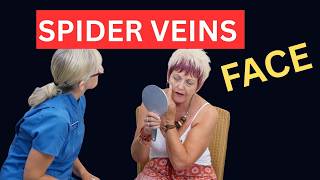 Facial Spider Vein Treatment: The Complete Step-by-Step SWD Protocol