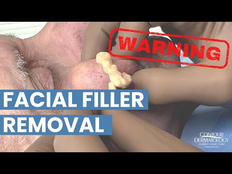 Removing YEARS OLD Facial Filler ⚠ Be careful where you get fillers from! ⚠ | CONTOUR DERMATOLOGY