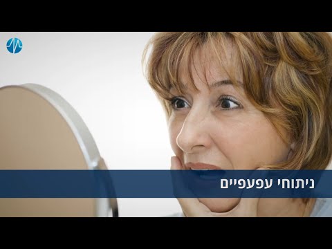 ניתוחי עפעפיים - ד