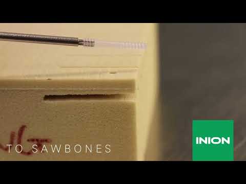 Inion CompressOn™ Screw's Compression Feature: Insertion to Sawbones and Bone