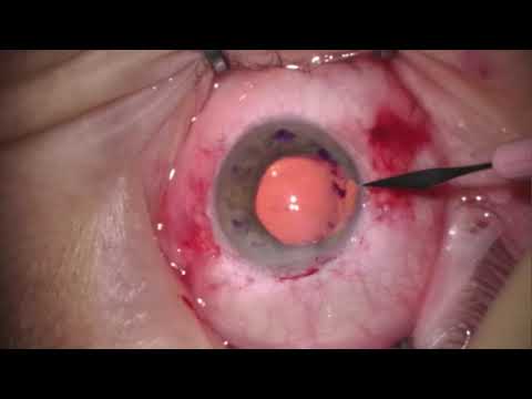 Impianto FIL SSF + DSAEK