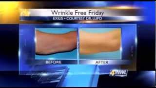 How to Tighten Skin on Sagging Arms with Exilis - Dr Mary Lupo