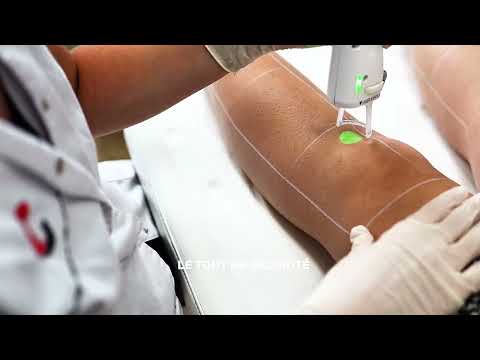 Vidéo : déroulé d'une séance d'épilation laser