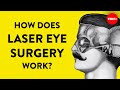 How Does Laser Eye Surgery Work Dan Reinstein