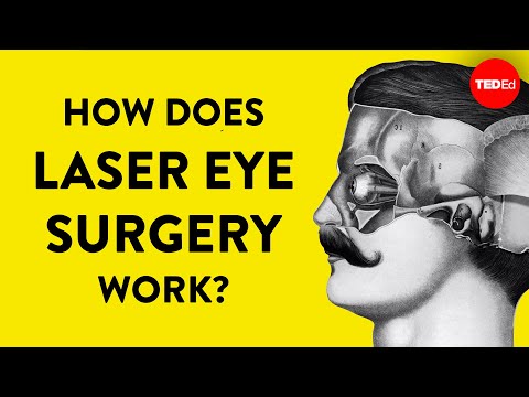 Chirurgie restaurare viziune termen