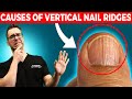 🖐Do you have Vertical Nail Ridges?  [Causes & Treatment]🖐