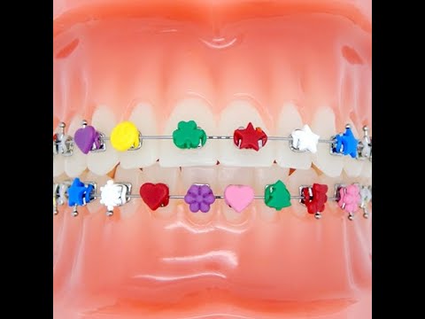 Braces by You