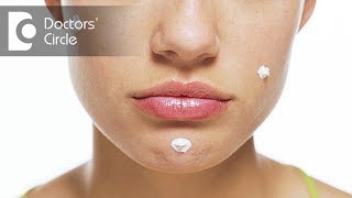 What causes large raised red bump on face and its management? - Dr. Sudheendra Udbalker