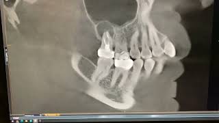 Everything You Need To Know About Root Canals: The Biological Root Canal Oxymoron