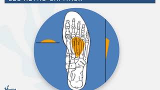 Principe de traitement des métatarsalgies