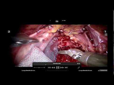 Nerve Sparing Robotic Prostatectomy with Novel Use of an Amnion Adhesion Barrier