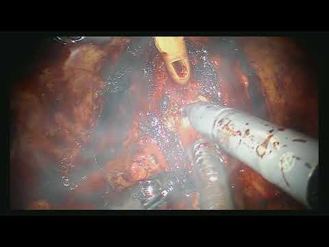 BPH negli uomini per rimuovere le recensioni di funzionamento Sealeks prostatite