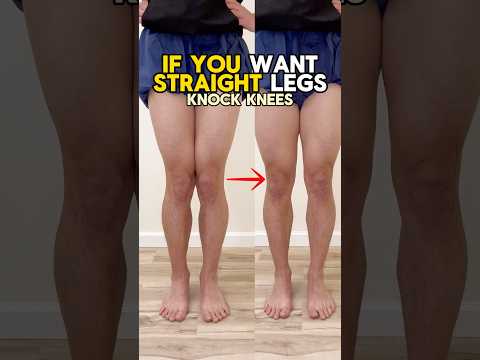 Leg Posture: How to fix your knock knee posture!
