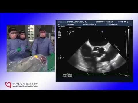 TAVI SUMMIT 2014_Live Case Demonstration & Lecture II