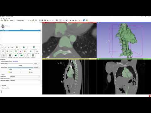 Fast marching segmentation in 3D Slicer