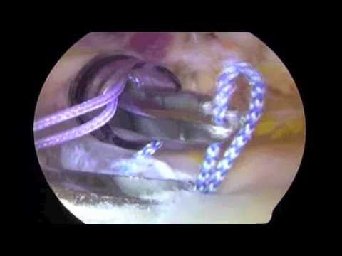 Small Arthroscopic Rotator Cuff Repair with Subacromial Decompression 