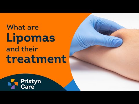 What are Lipomas & Their treatment