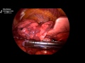 VATS Right Upper Lobe Anterior (S3) Segmentectomy