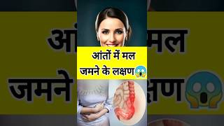 Download lagu आंतों में मल जमने के लक्षण 😱| Anto me mal chipakna  #aidoctor #healthytips #short mp3