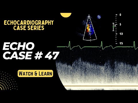 Echocardiography Case 47: Echo Spot Diagnosis Series