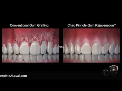 Pinhole Surgical Technique (PST) Dr  Raluca Bota - DentisteALaval.com