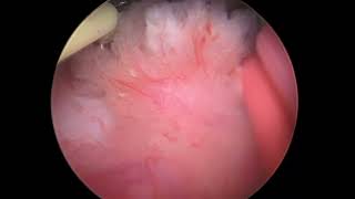 Core Videos (2024): Transurethral Resection of Bladder Tumor with Staccato Technique