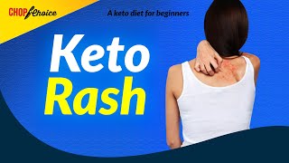What is Keto Rash❓ l How to Cure the Keto Rash❓