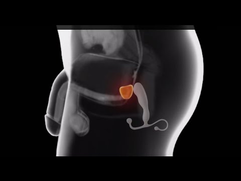 Come mosazhirovat prostata Come trattare linfiammazione della adenoma prostatico