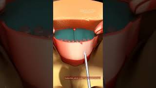 Download lagu Anesthesia process during caesarean birth #birth #giving birth #pregnancytips #healthtips #education mp3