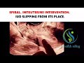 SPIRAL INTRUTERINE INTERVENTION.  IUD SLIPPING FROM ITS PLACE. #pregnancy #pregnancytips #ultrasound