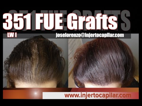 351FUE Grafts. FAGA LWI. Medical treatment + small restoration.Injertocapilar.com.2459/2019