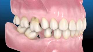 Consecuencias Pérdida dental Clinica dental Murcia - Clínica Dental Vistabella
