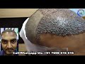 Live Hair Transplant Surgery Dense Hair Transplantation Best Hair Transplant Clinic In India