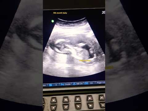 baby heartbeat | 4 th month | baby movements #baby #ntscan #scan #hearbeat #babymovement