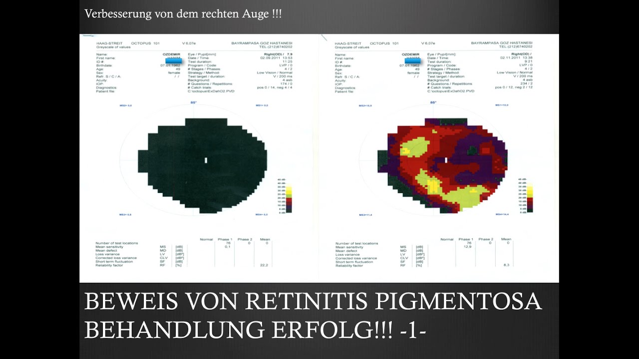 Gesichtsfeldtests 1 -Retinitis Pigmentosa Behandlung- FIRATLI KLINIK