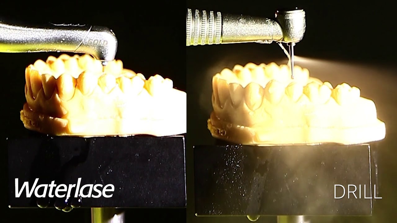 Waterlase vs Drill Less Water | Waterlase creates 98% fewer Aerosols