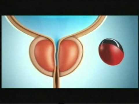 Stechender Schmerz im Bauch Prostata Schläfrigkeit bei Prostatakrebs
