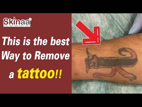 Harish's Pico Laser Tattoo Removal Procedure At Skinaa | बिना किसी दर्द ट