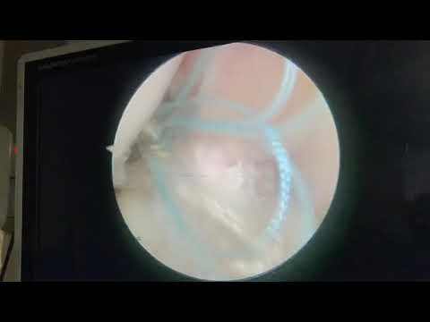 My ACL Surgery Video Literally Blew my Mind! How do they do this!!! Thanks Dr Manit Arora