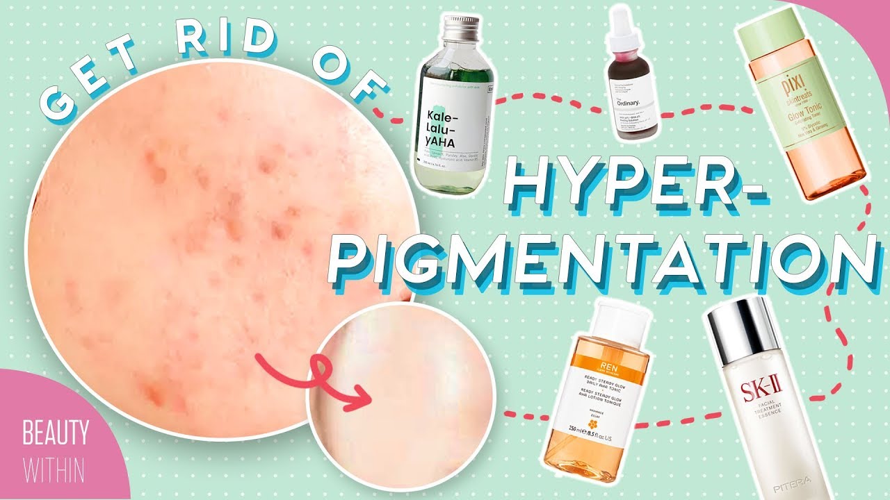 Best Ways to Reduce Hyperpigmentation & Dark Spots: Ingredients, Products & Natural Remedies - YouTube