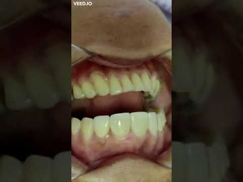 Diseño de sonrisa con carillas cerámicas en zirconio monolítico en Barranquilla - Odontólogo