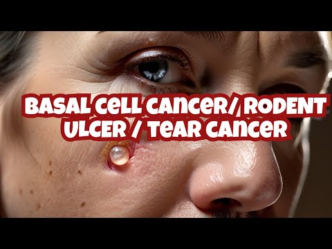 Basal cell carcinoma of skin (Rodent ulcer/ Tear cancer) risk factors, symptoms and treatment