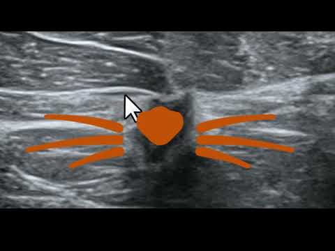 Alterações nos ligamentos de Cooper como auxiliares no diagnóstico ecográfico de nódulos mamários.