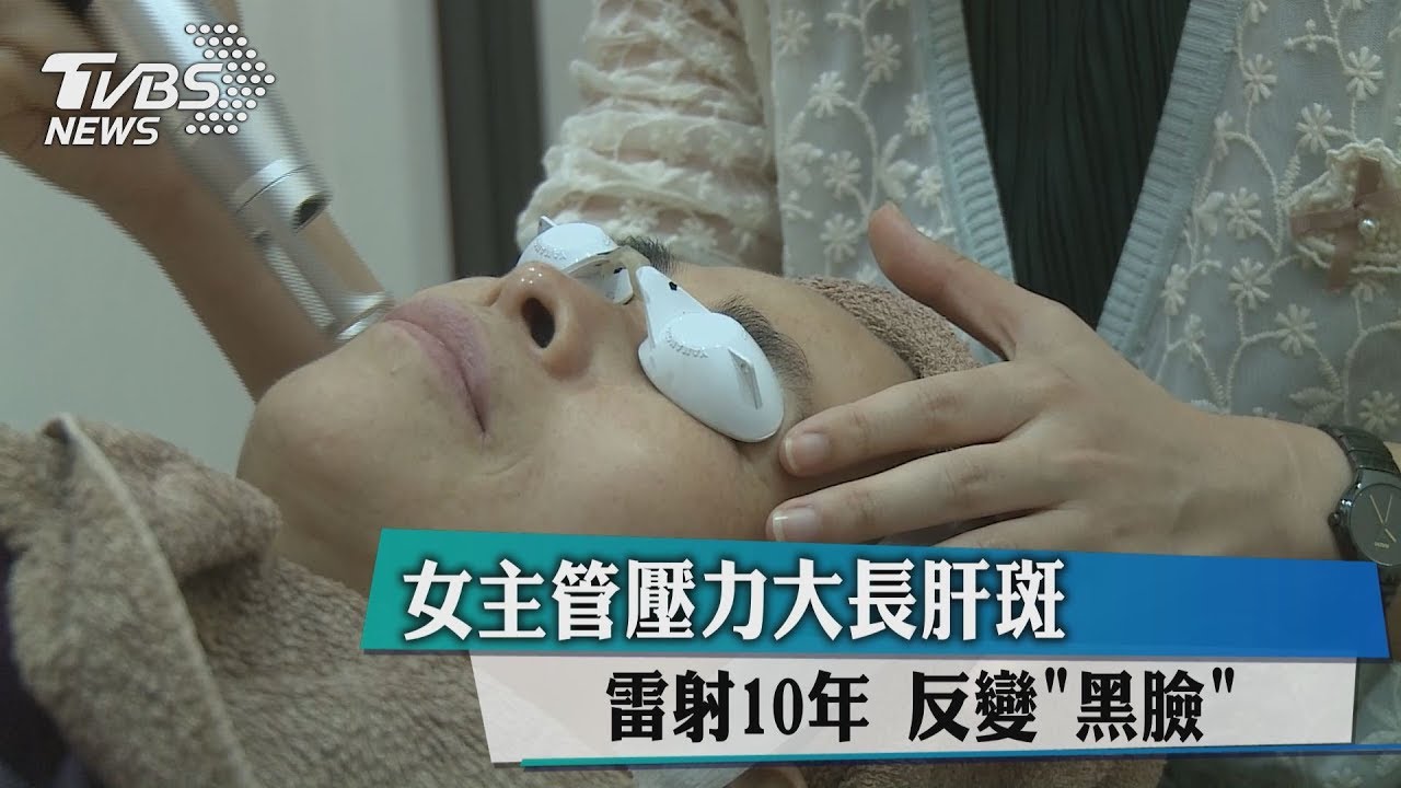 女主管壓力大長肝斑 雷射10年反變「黑臉」