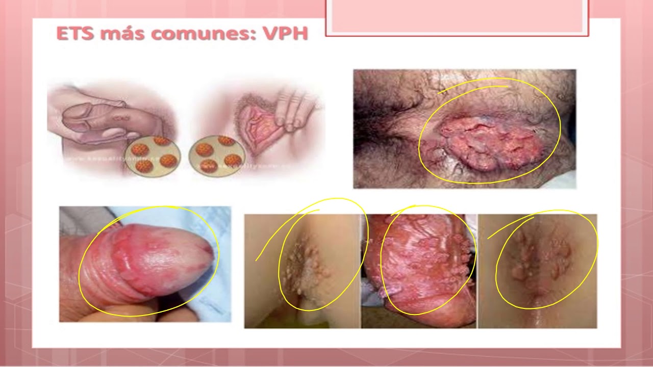 ITS de origen viral VHP, VIH, VHB, VHS 2